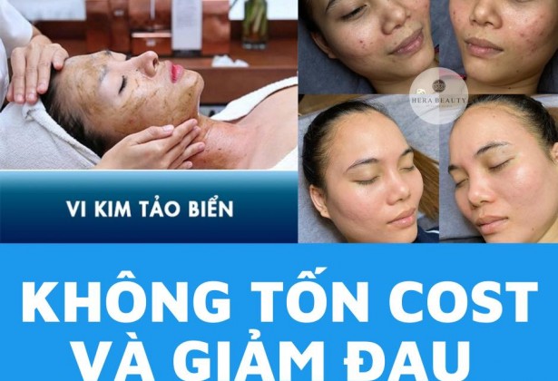 Quy trình Vi Kim Tảo Biển Không tốn nhiều Cost - Gảm đau tối đa