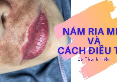 Nguyên nhân gây nám ria mép và cách điều trị