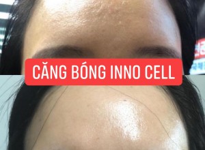 Những sai lầm khi làm căng bóng da
