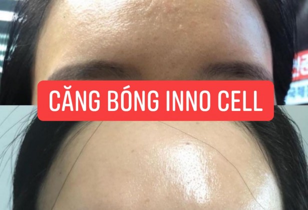 Những sai lầm khi làm căng bóng da