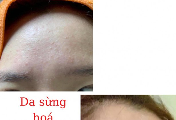 Quy trình làm căng bóng da p2