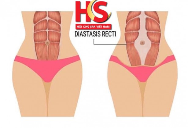 Để giảm mỡ bất bại chúng ta cần làm gì trước?