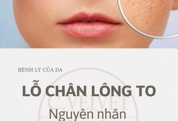 Điều Trị Lỗ Chân Lông To