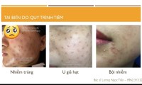 Xử Lý Tai Biến Khi Tiêm Meso