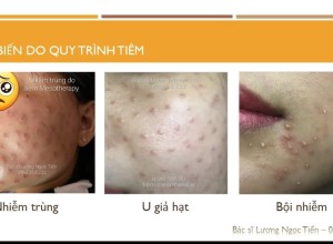Xử Lý Tai Biến Khi Tiêm Meso